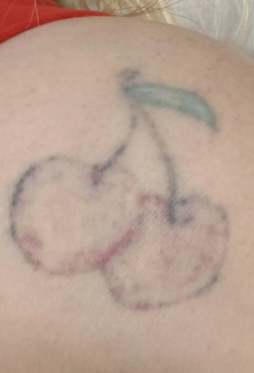 Depois: a tatuagem de cerejas bem mais clara após as sessões de laser